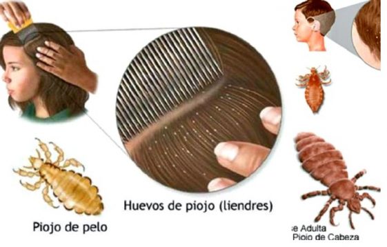 Rem Dio Natural Para Eliminar Piolhos E Fungos Em Horas Dicas De Beleza